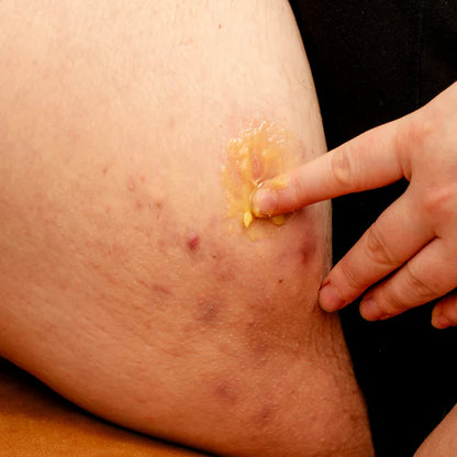 Universial Flare Care